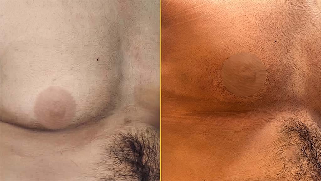 Gynecomastia (Male Boobs) Before and After