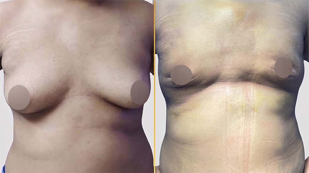 Gynecomastia (Male Boobs) Before and After