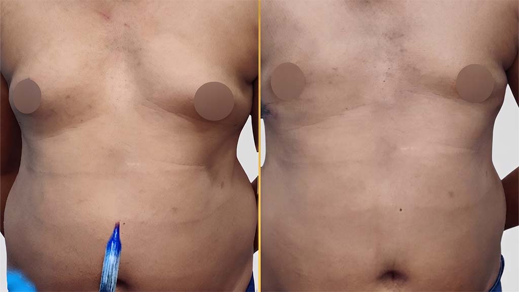 Gynecomastia (Male Boobs) Before and After