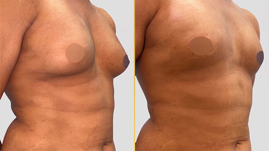 Gynecomastia (Male Boobs) Before and After