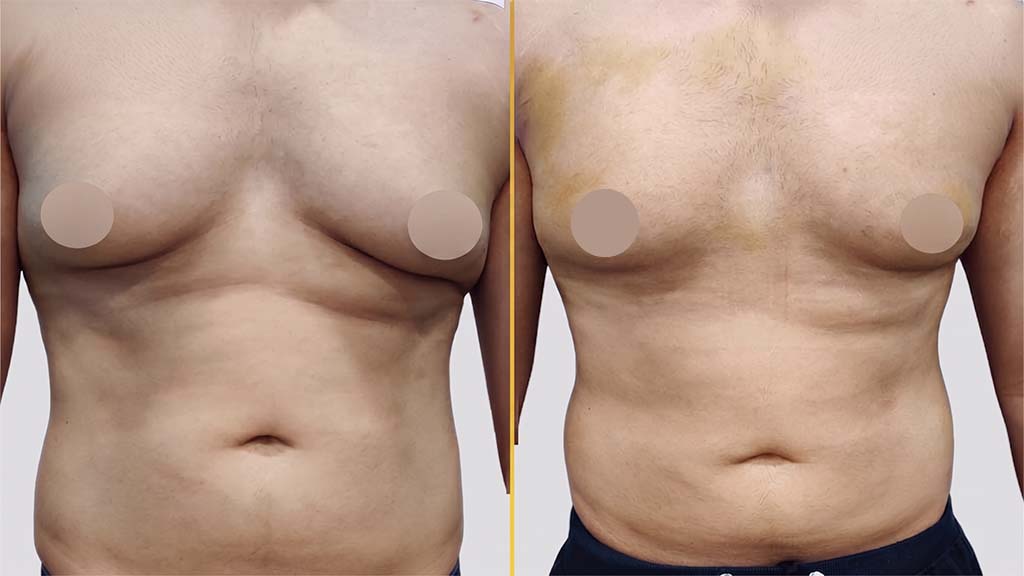 Gynecomastia (Male Boobs) Before and After