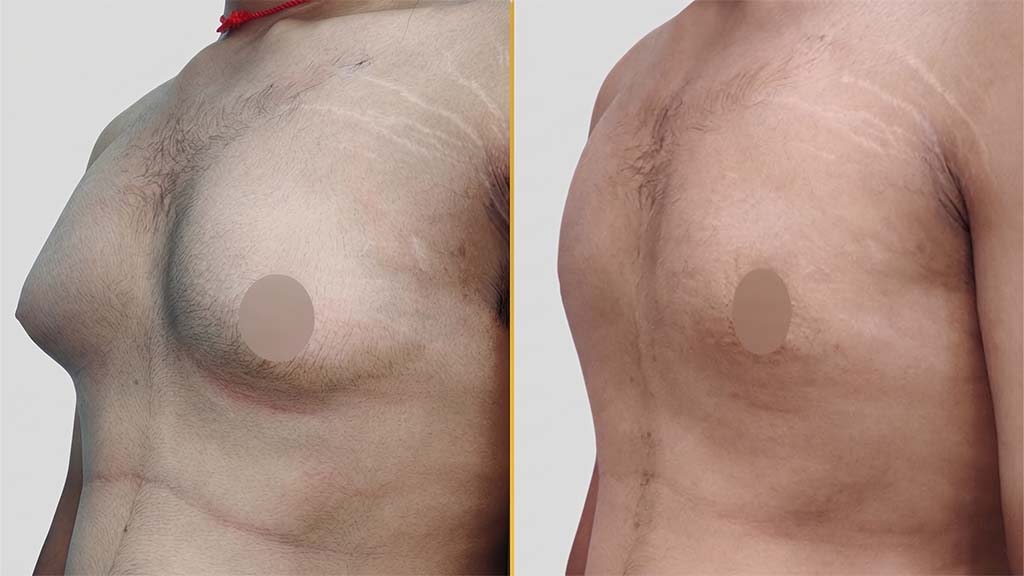 Gynecomastia (Male Boobs) Before and After