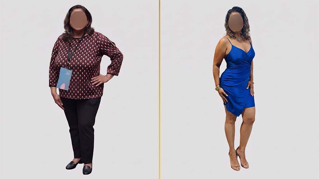 Mommy Makeover Before and After