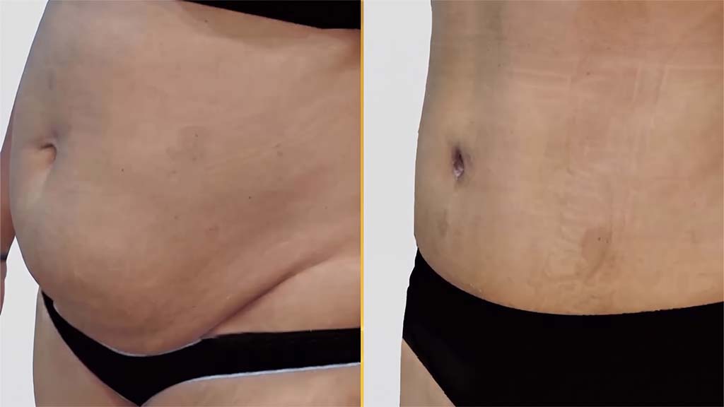 Mommy Makeover Before and After