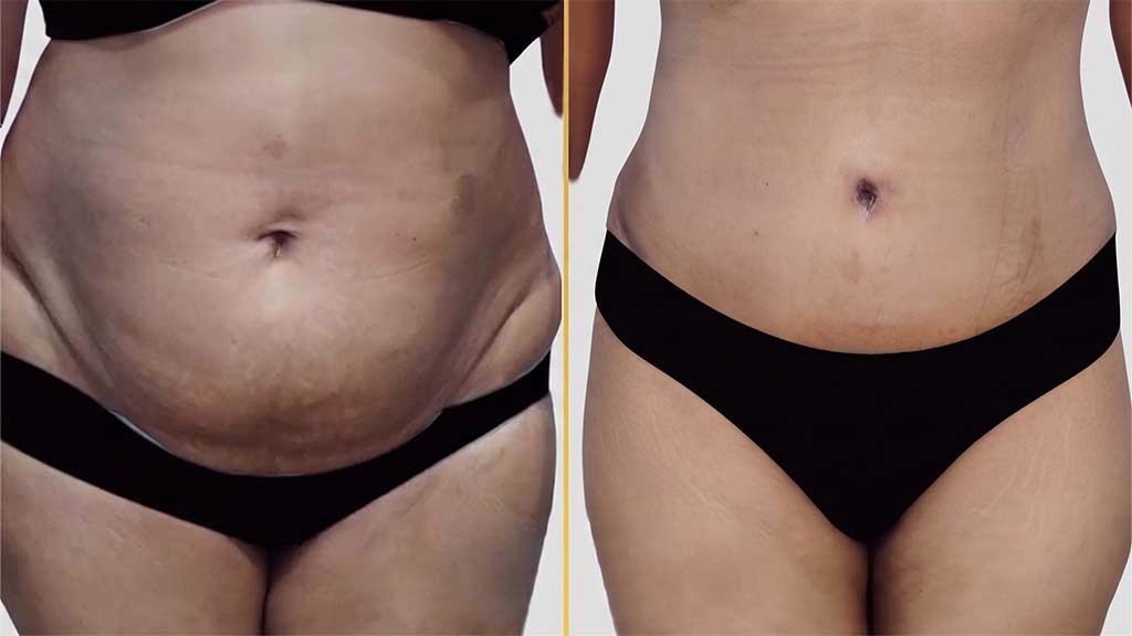 Mommy Makeover Before and After