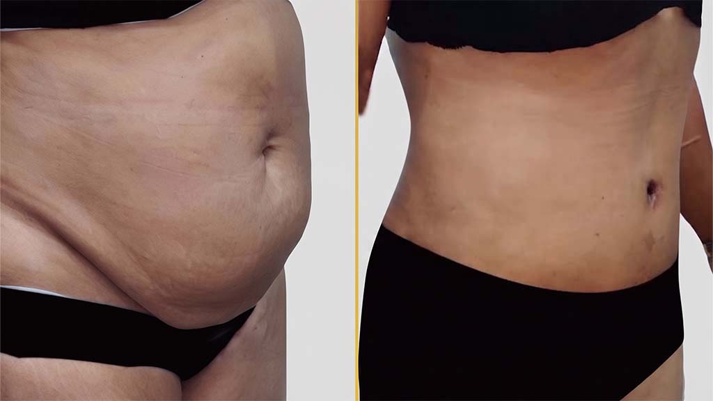 Mommy Makeover Before and After