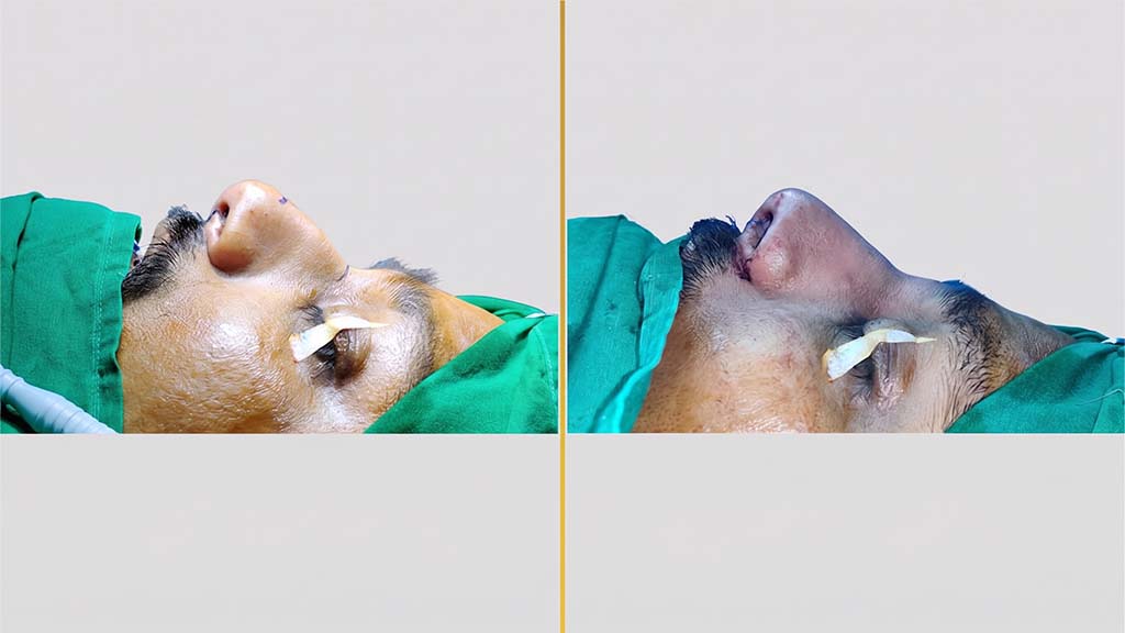 Rhinoplasty Before and After