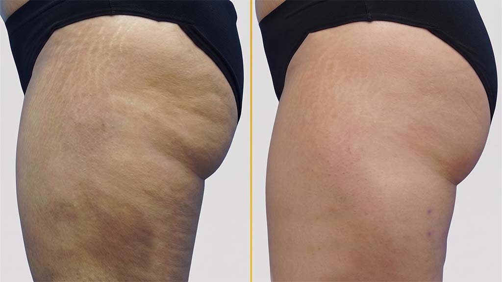 Thigh Contouring Before and After