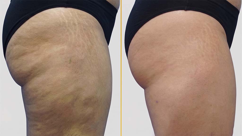 Thigh Contouring Before and After