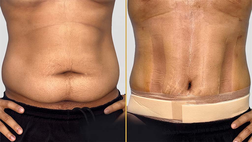 Hi-Definition Liposuction Before and After