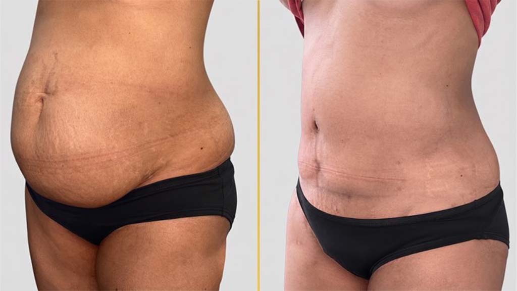 Tummy Tuck Before and After