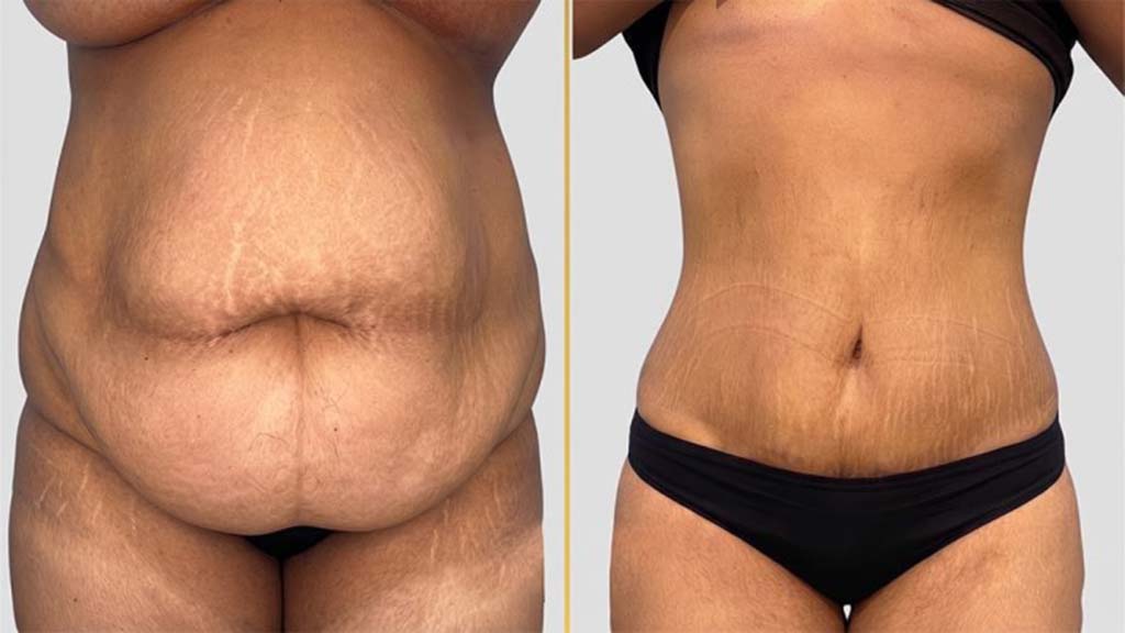 Tummy Tuck Before and After