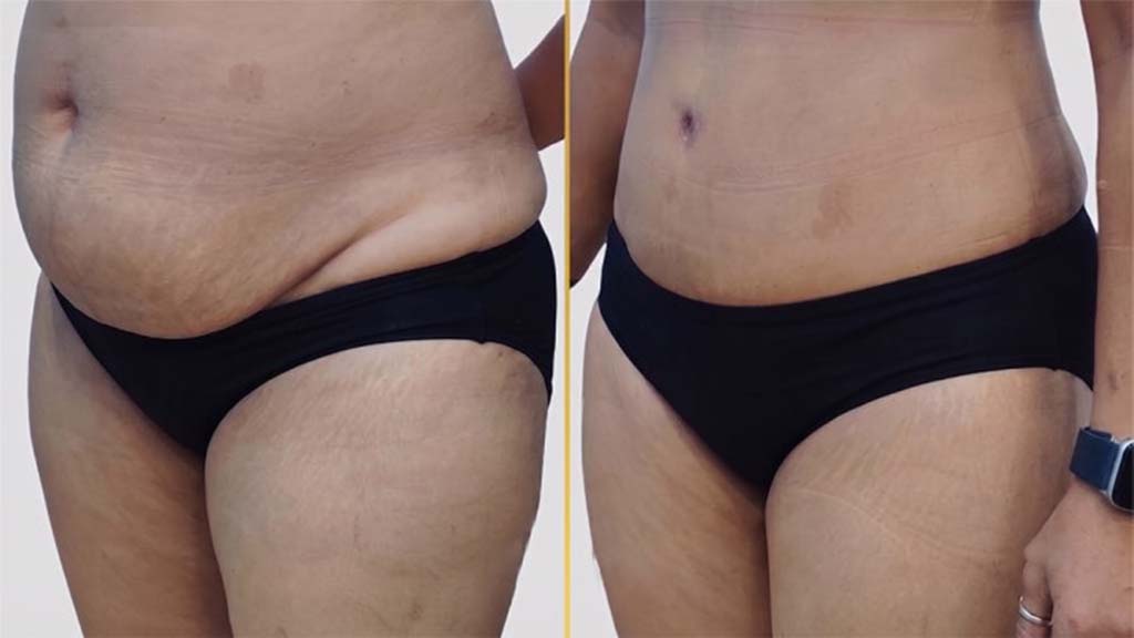 Tummy Tuck Before and After