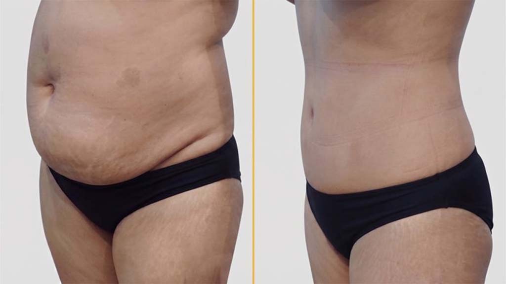 Tummy Tuck Before and After