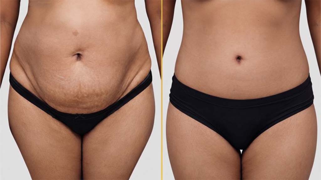Tummy Tuck Before and After