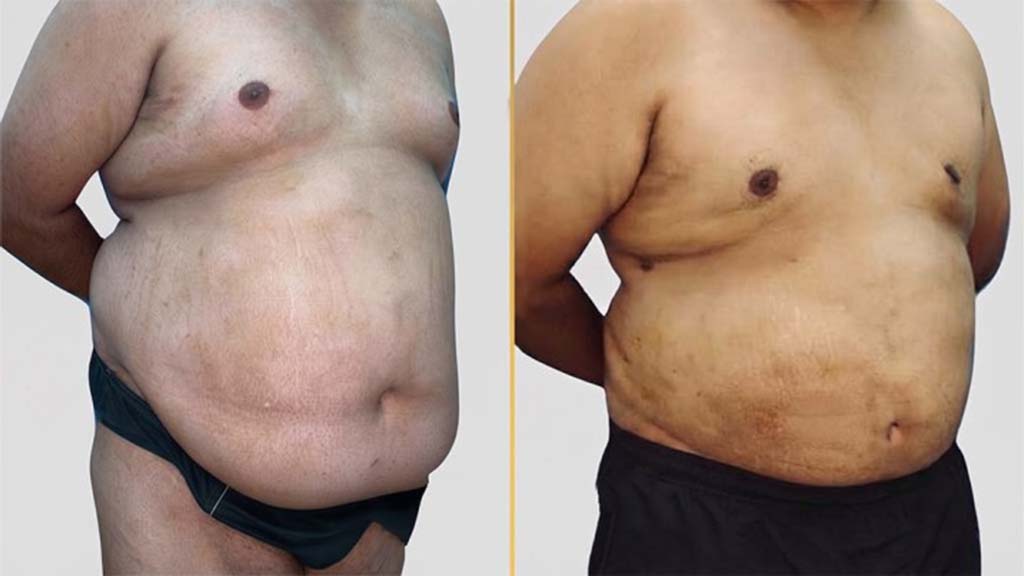 Tummy Tuck Before and After