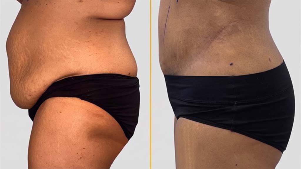 Tummy Tuck Before and After