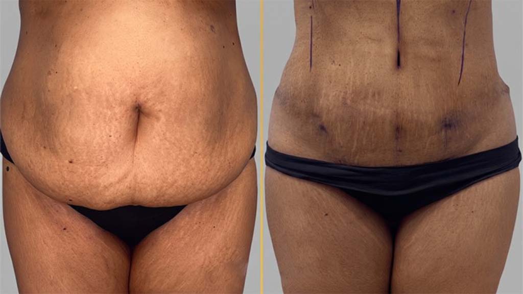 Tummy Tuck Before and After