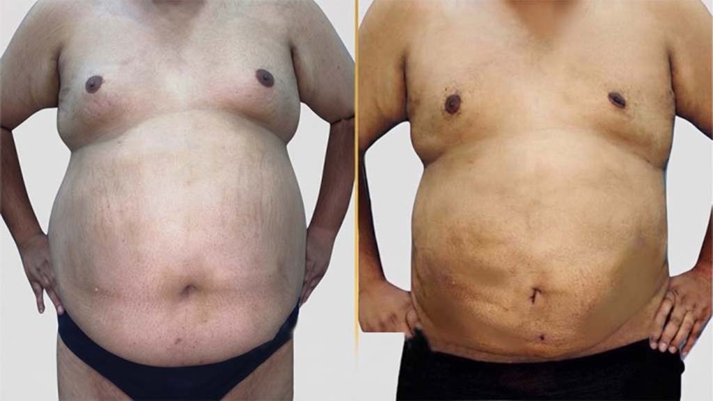 Tummy Tuck Before and After