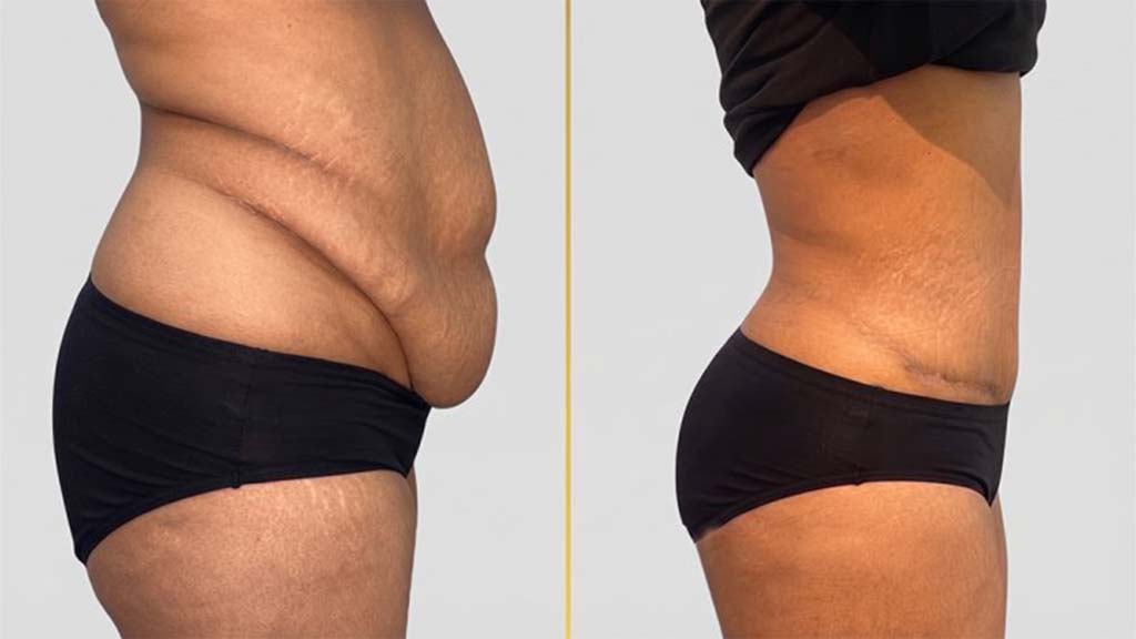 Tummy Tuck Before and After