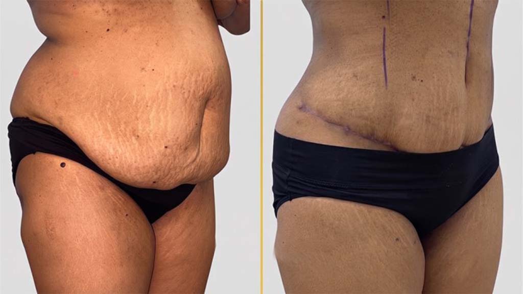 Tummy Tuck Before and After