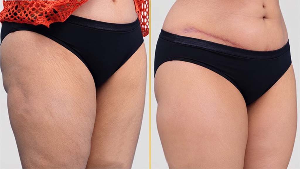 Tummy Tuck Before and After