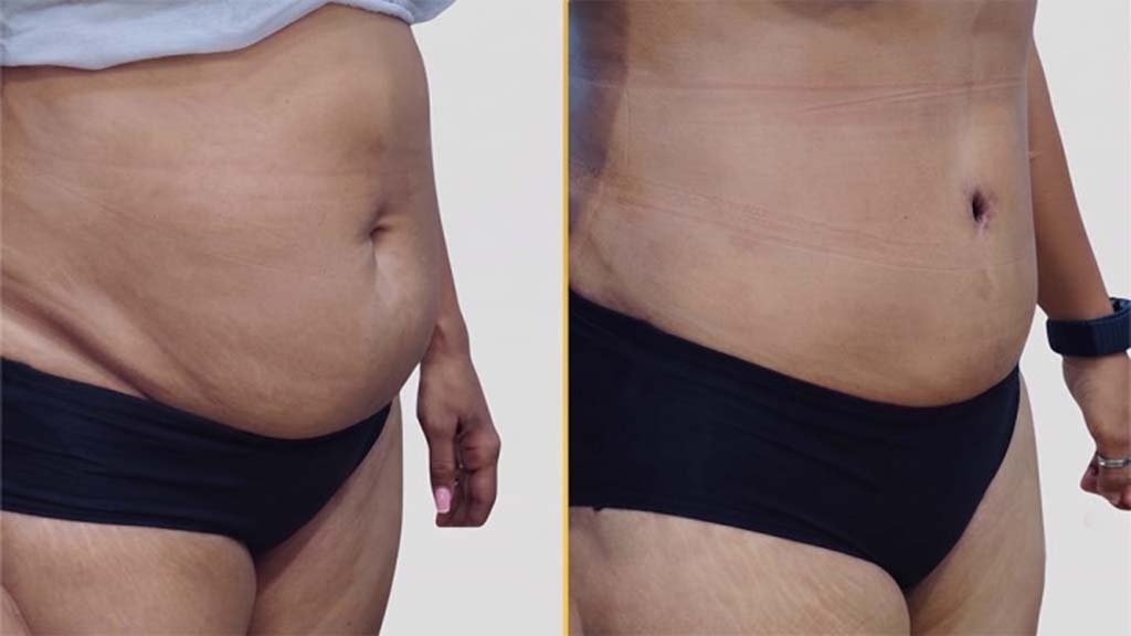 Tummy Tuck Before and After