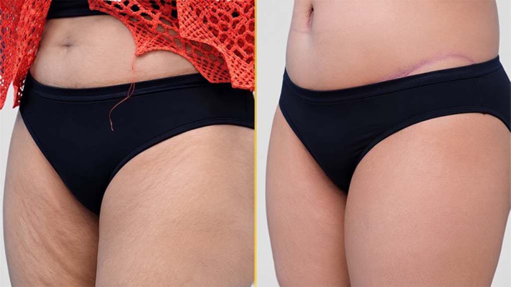 Tummy Tuck Before and After