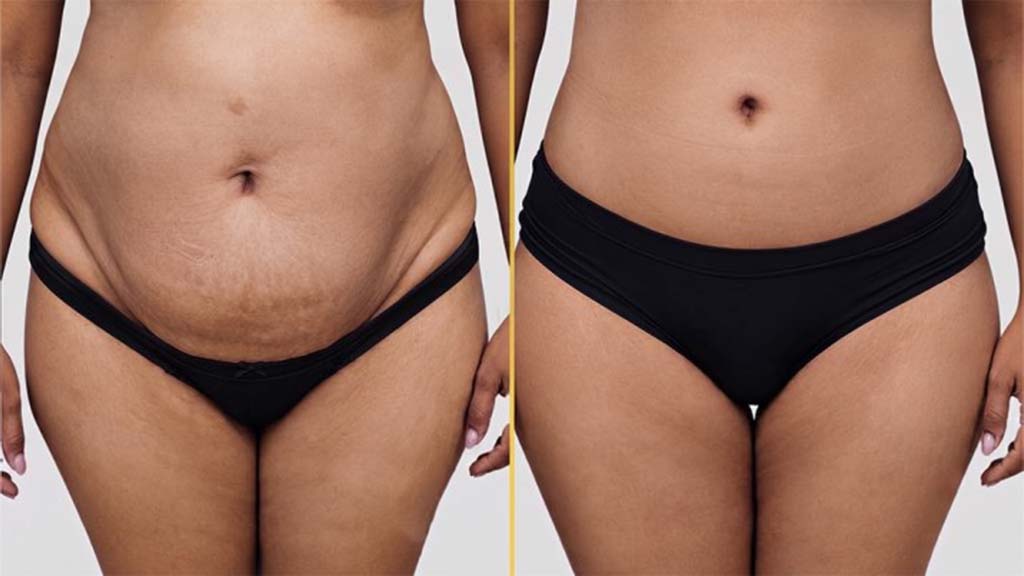 Tummy Tuck Before and After