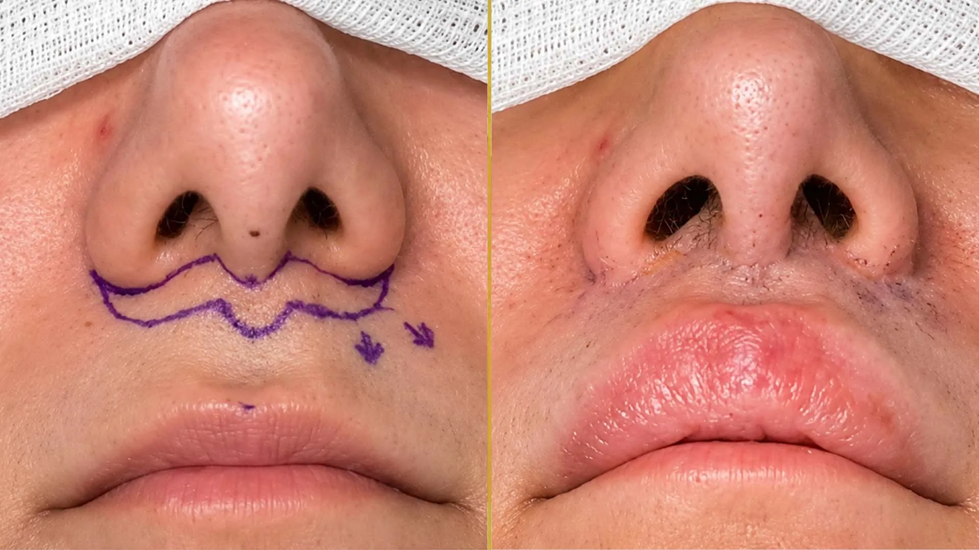 Lip Augmentation/Reduction before and after result - The Hair and Shape Clinic, Mumbai