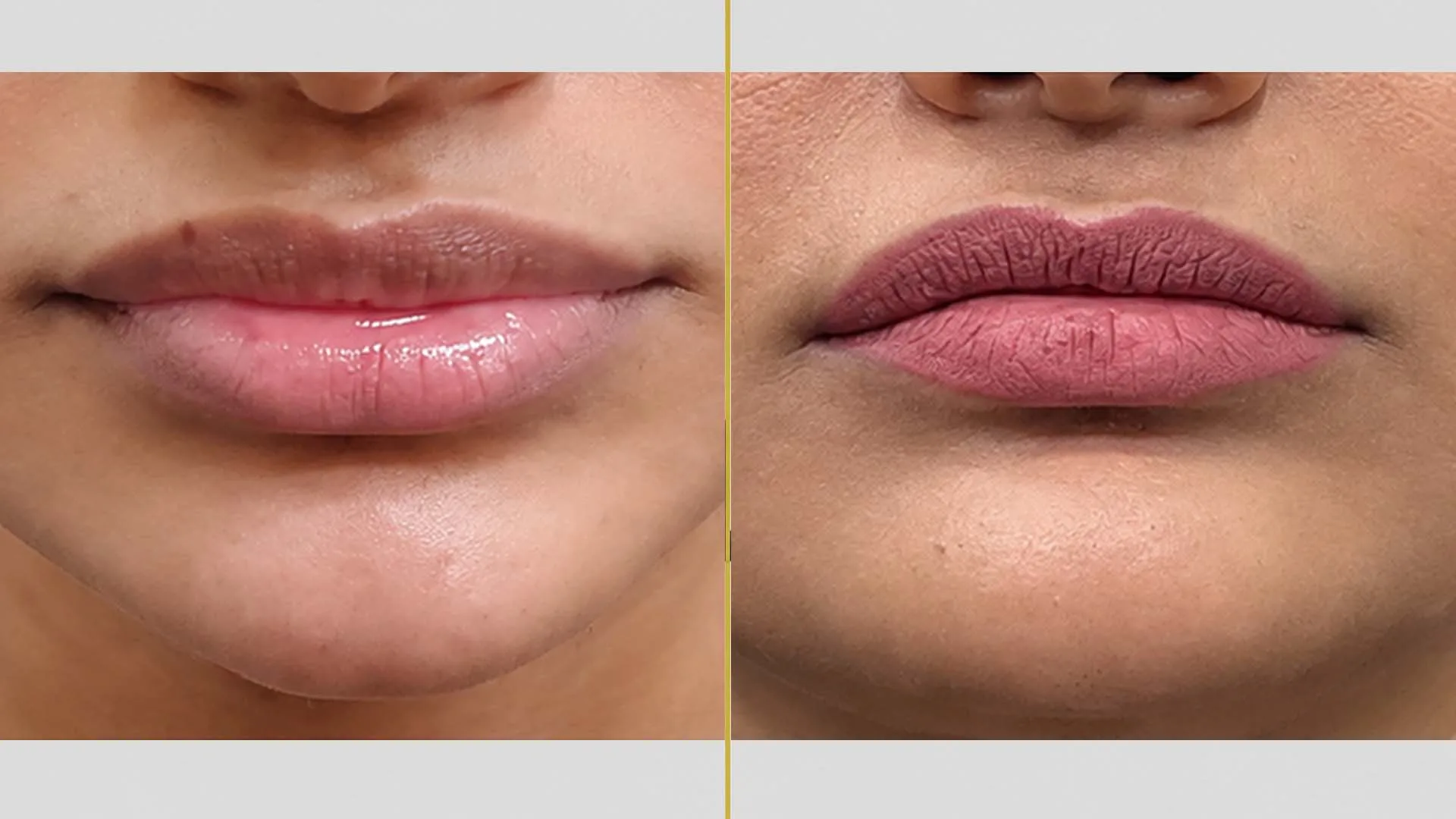 Lip Augmentation/Reduction before and after result - The Hair and Shape Clinic, Mumbai