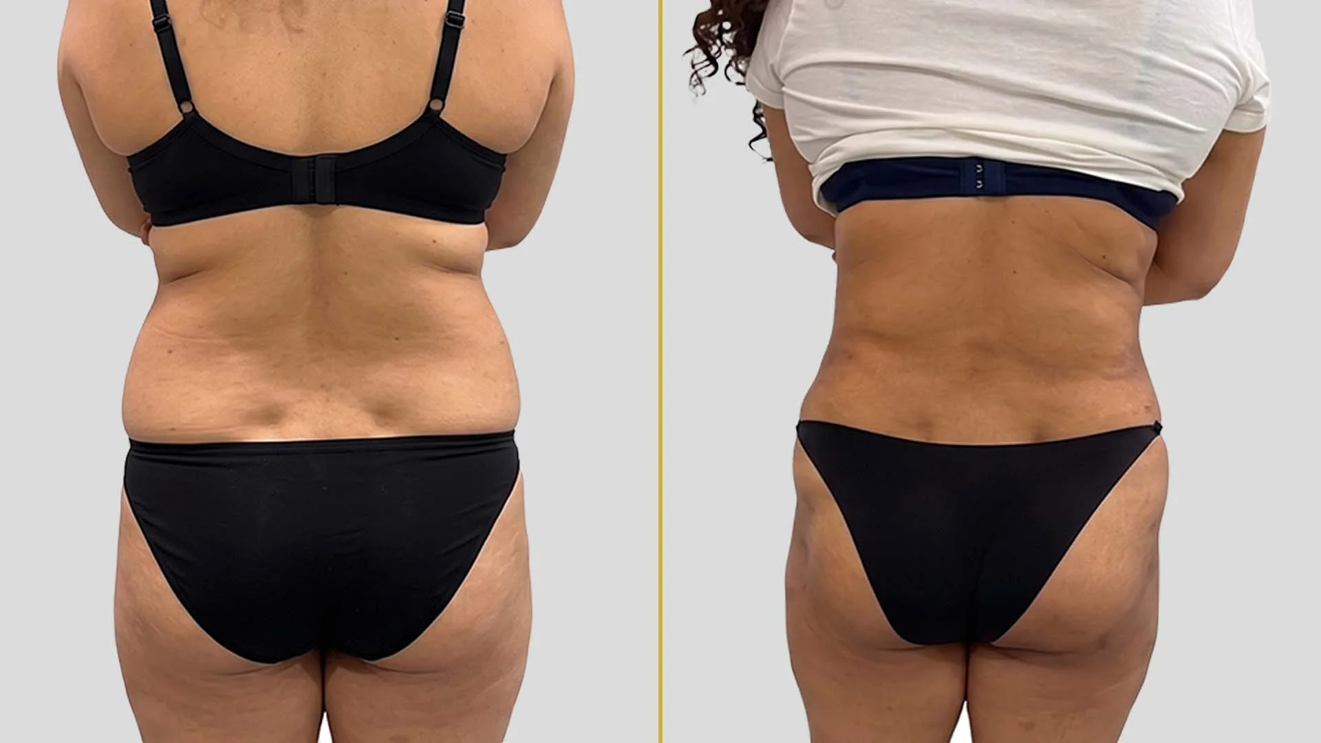Liposuction before and after result - The Hair and Shape Clinic, Mumbai