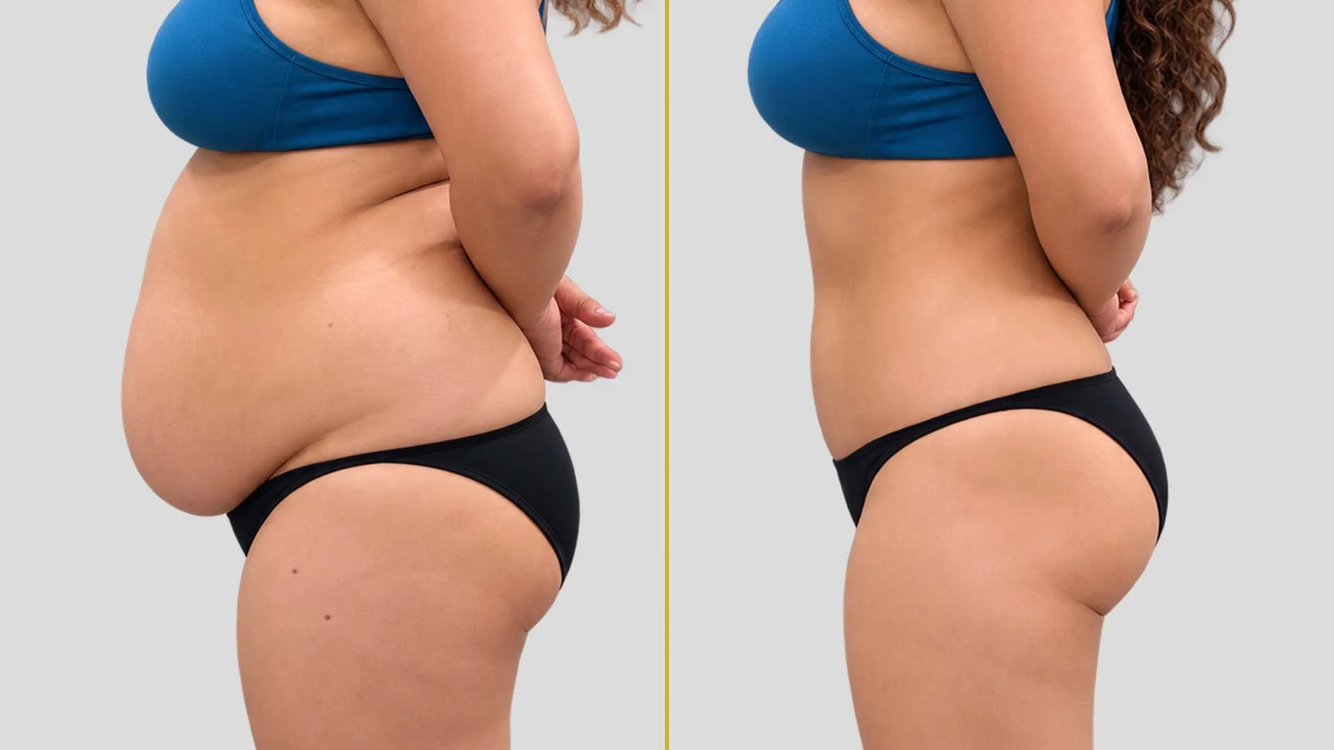 Liposuction before and after result - The Hair and Shape Clinic, Mumbai