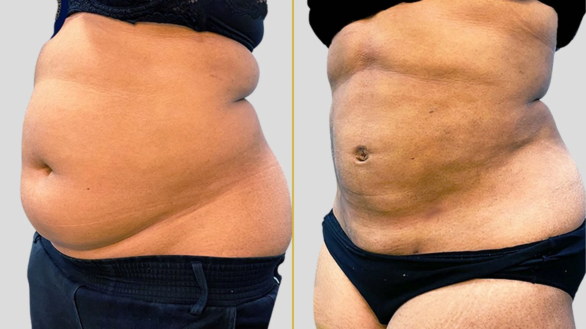 Liposuction before and after result - The Hair and Shape Clinic, Mumbai