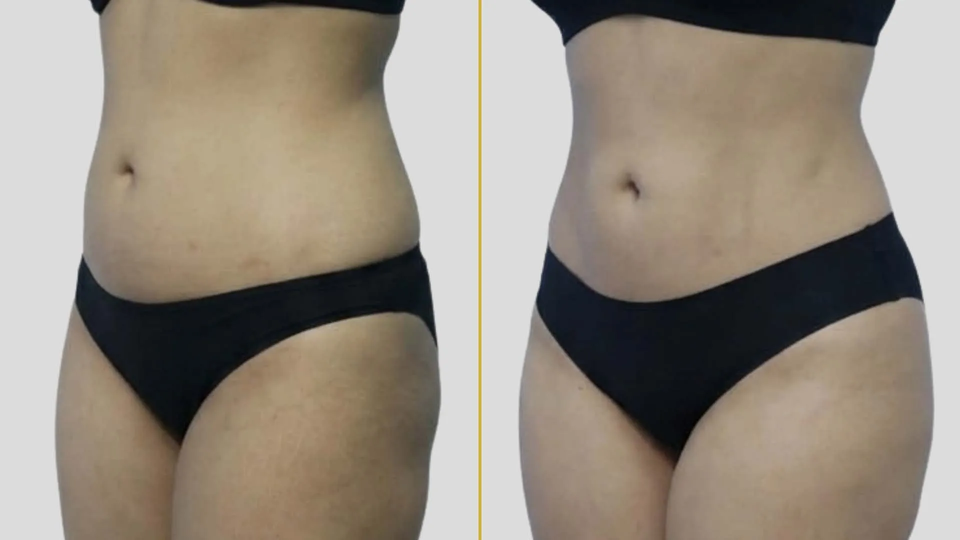 Liposuction before and after result - The Hair and Shape Clinic, Mumbai