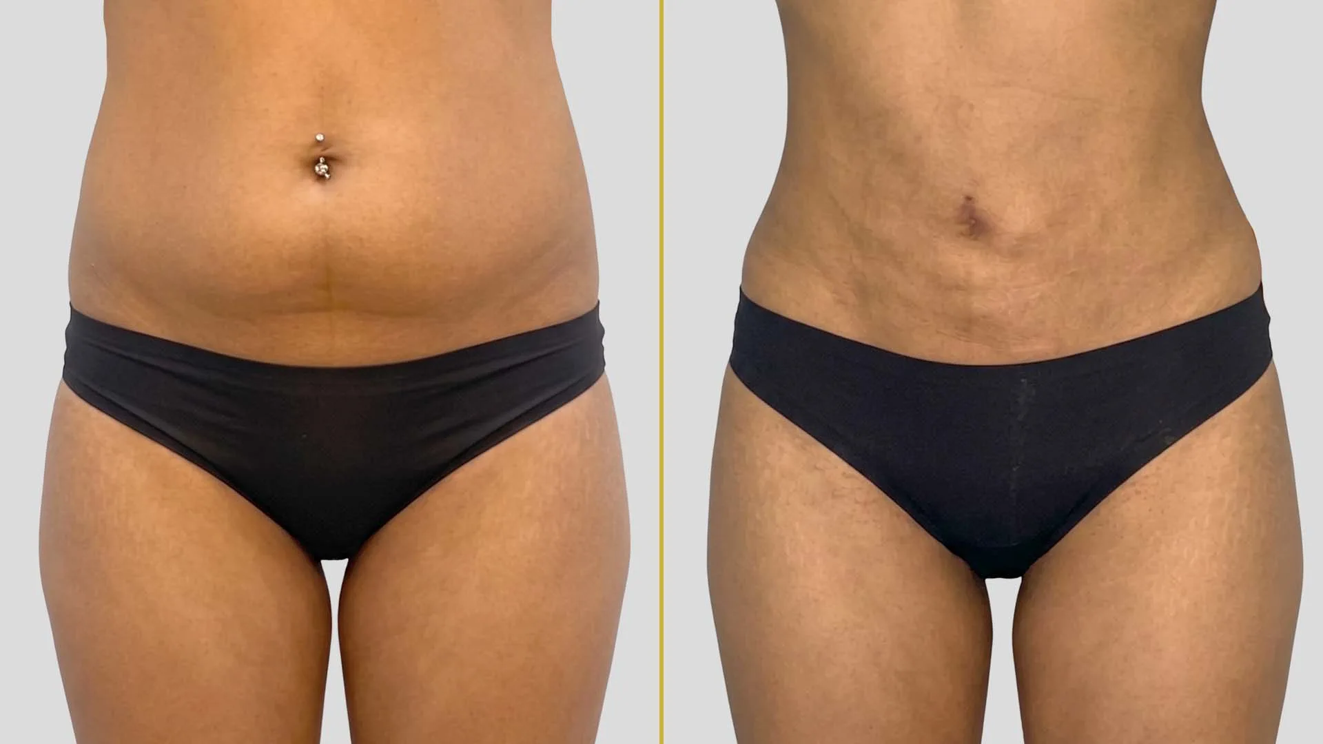 Liposuction before and after result - The Hair and Shape Clinic, Mumbai