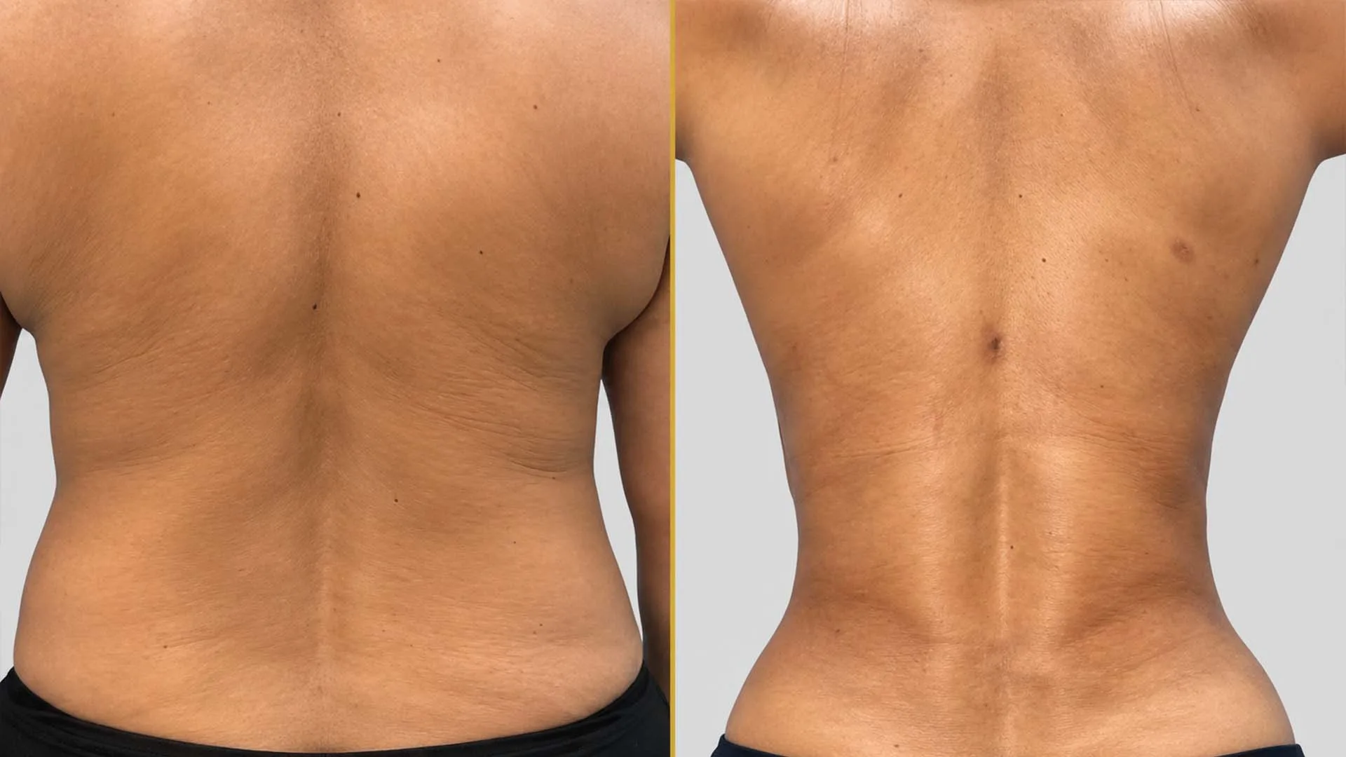 Liposuction before and after result - The Hair and Shape Clinic, Mumbai