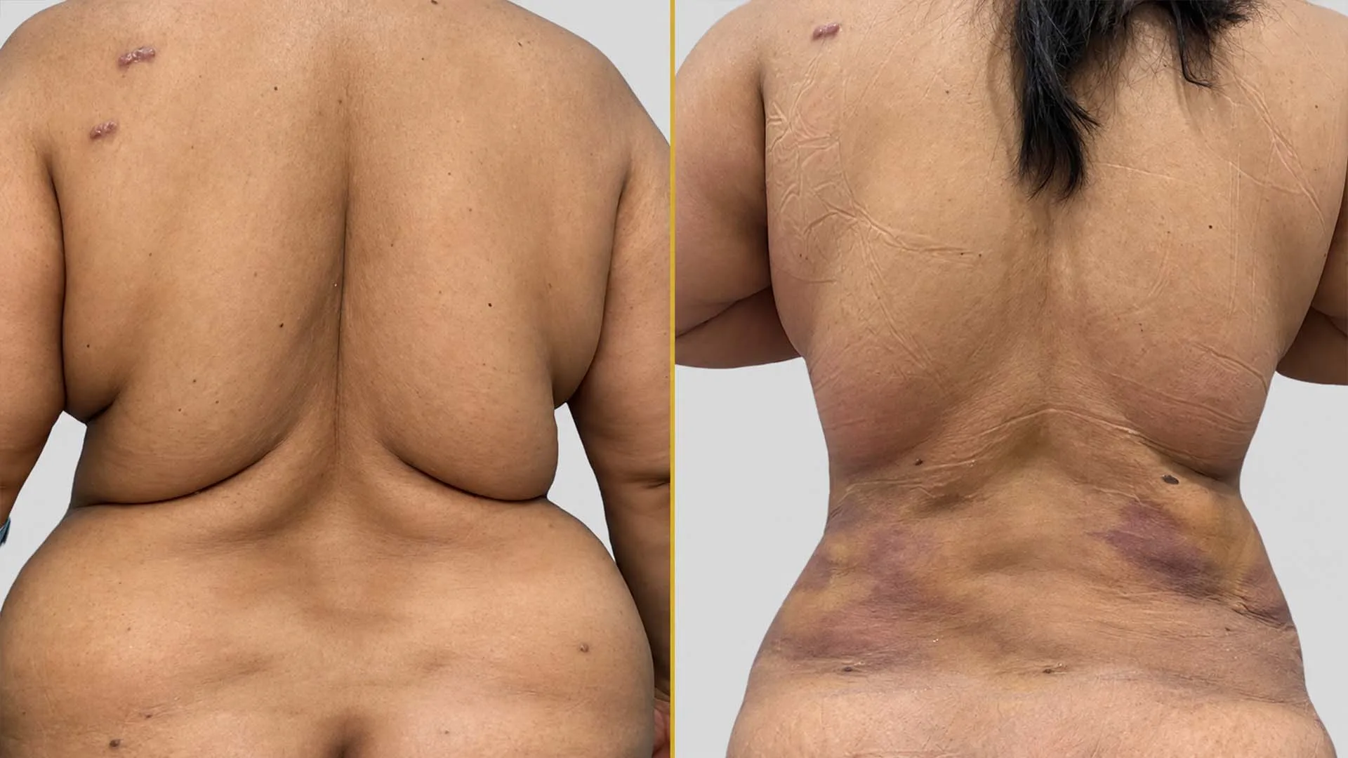 Liposuction before and after result - The Hair and Shape Clinic, Mumbai