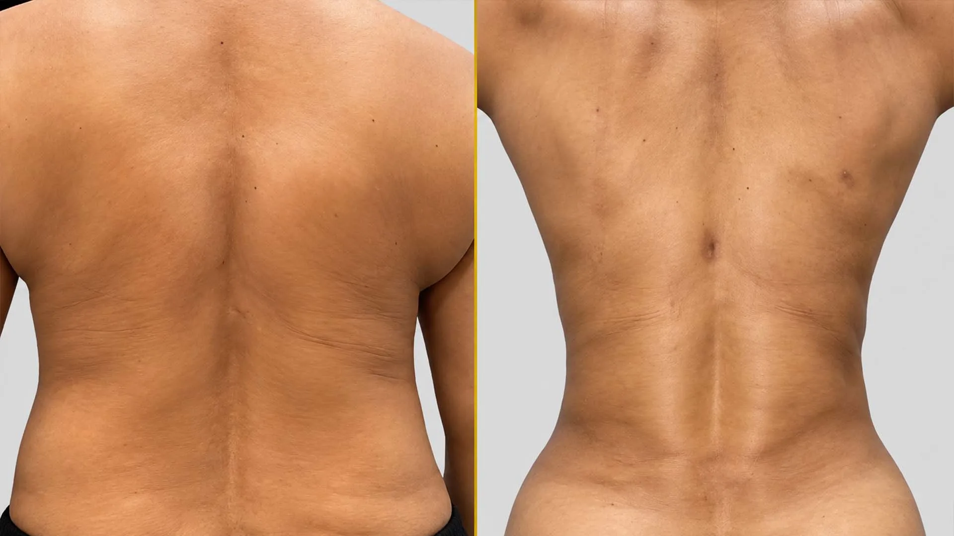 Liposuction before and after result - The Hair and Shape Clinic, Mumbai