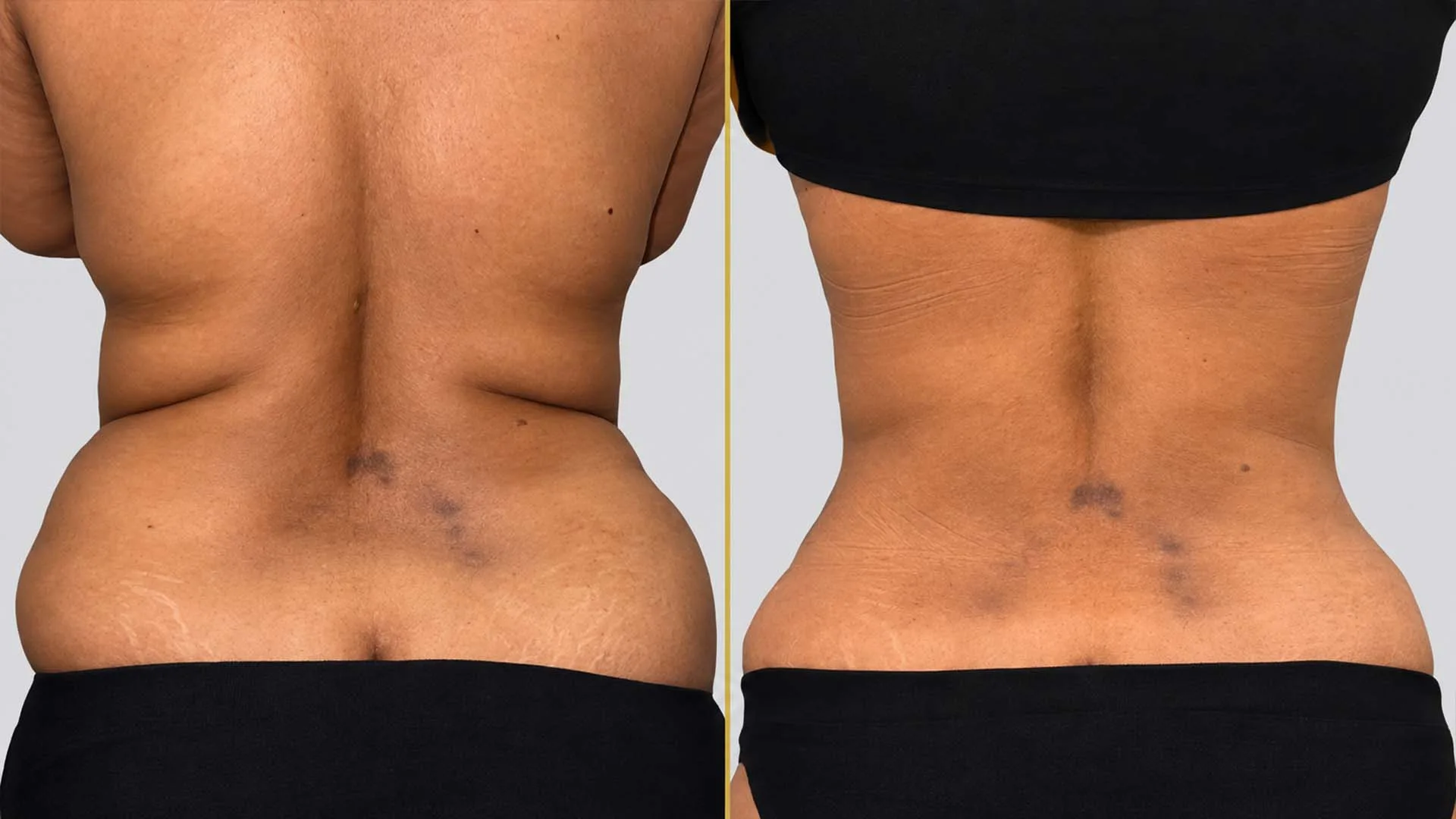 Liposuction before and after result - The Hair and Shape Clinic, Mumbai