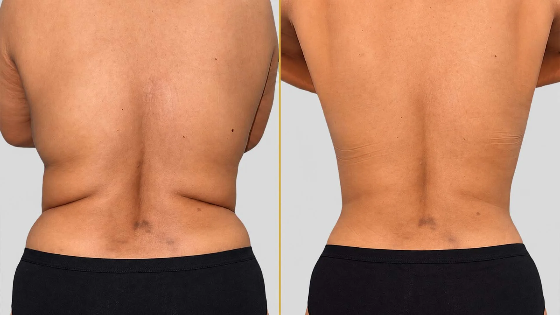 Liposuction before and after result - The Hair and Shape Clinic, Mumbai