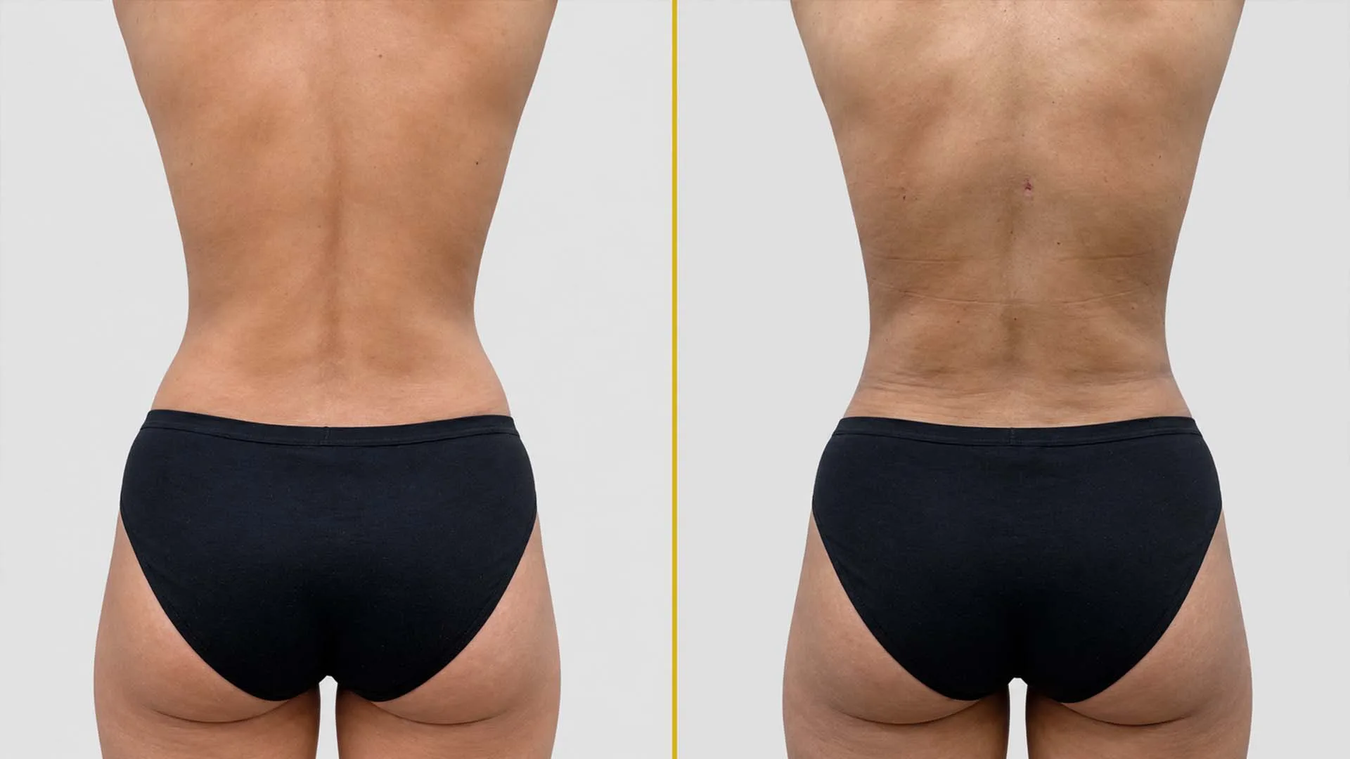 Liposuction before and after result - The Hair and Shape Clinic, Mumbai