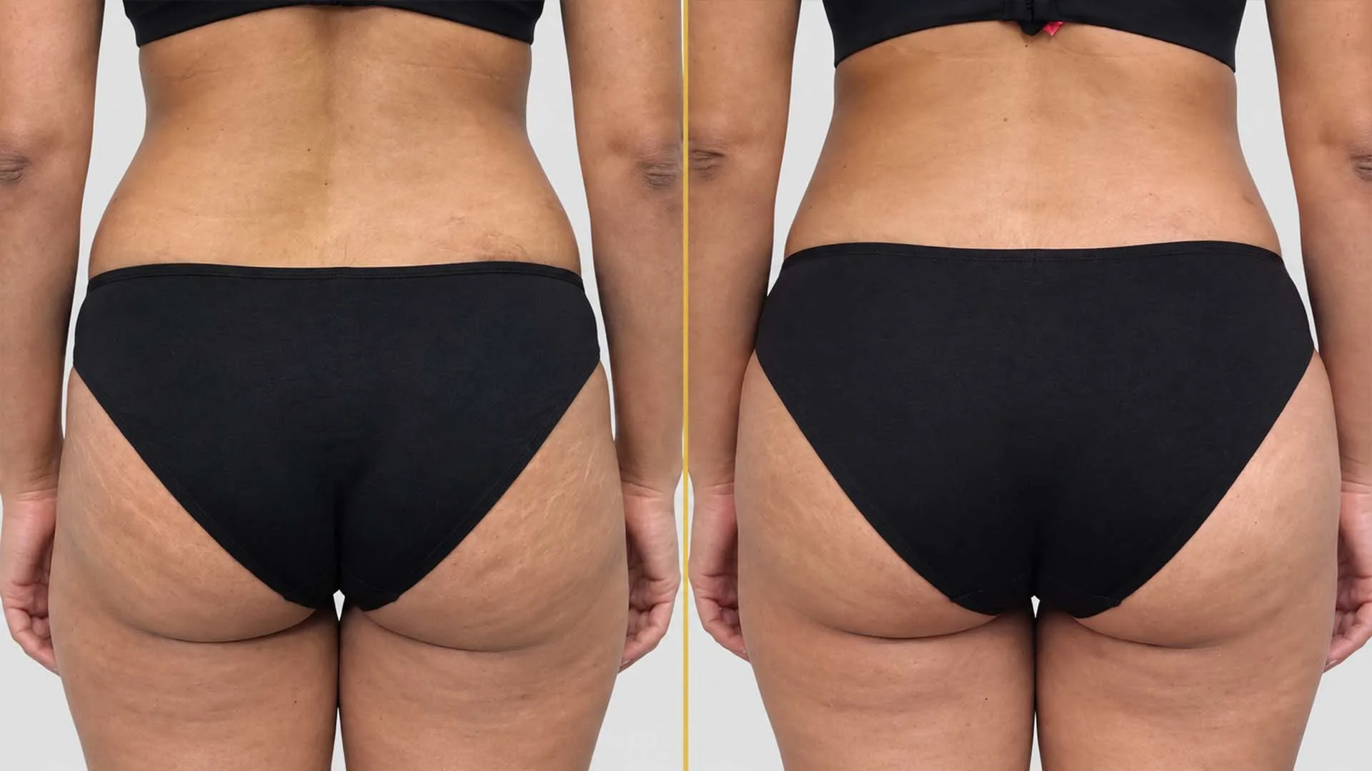 Liposuction before and after result - The Hair and Shape Clinic, Mumbai