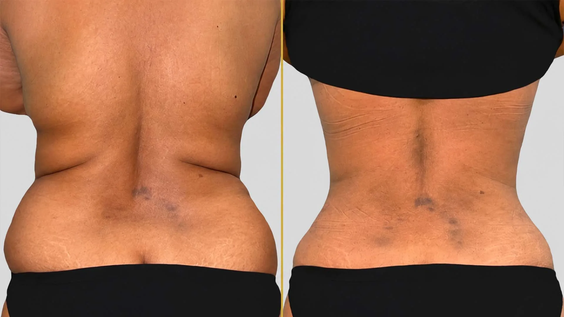 Liposuction before and after result - The Hair and Shape Clinic, Mumbai