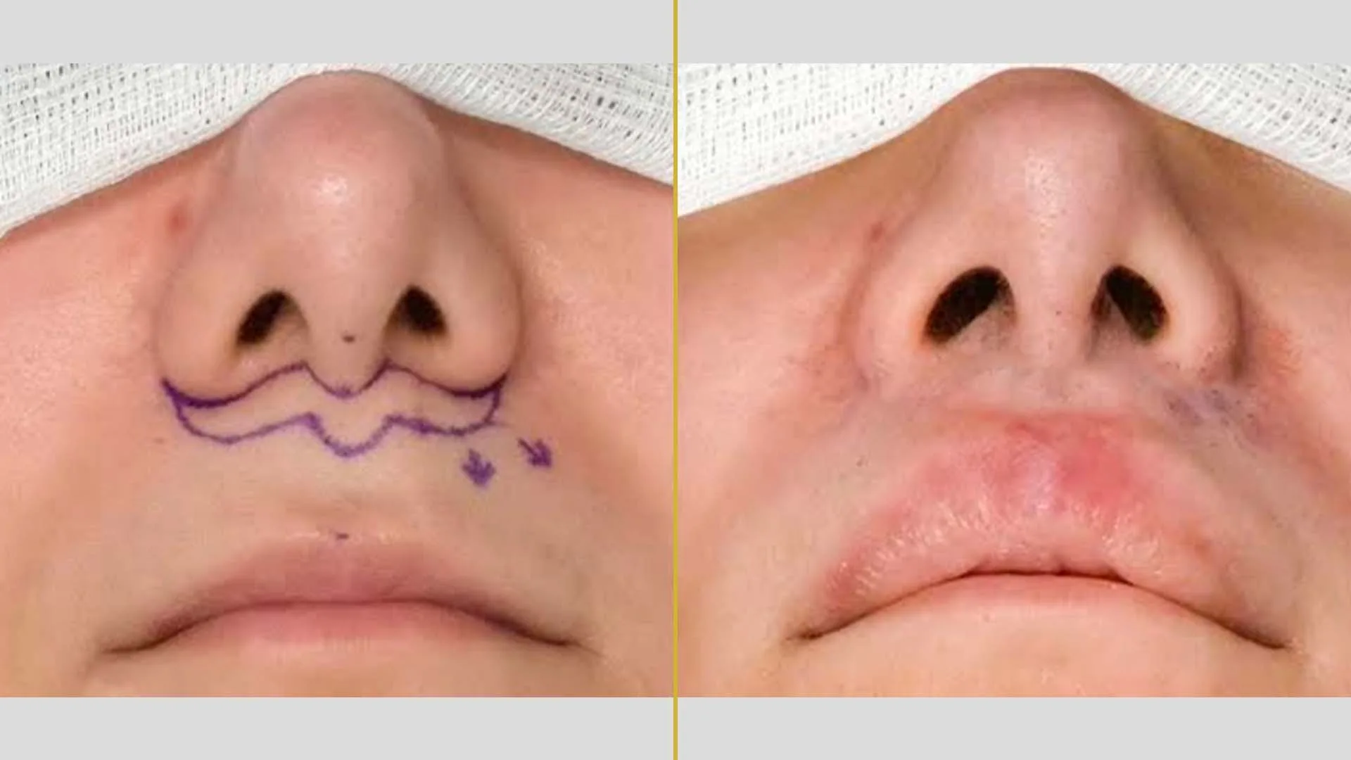 Mustache Hair Transplant before and after result - The Hair and Shape Clinic, Mumbai