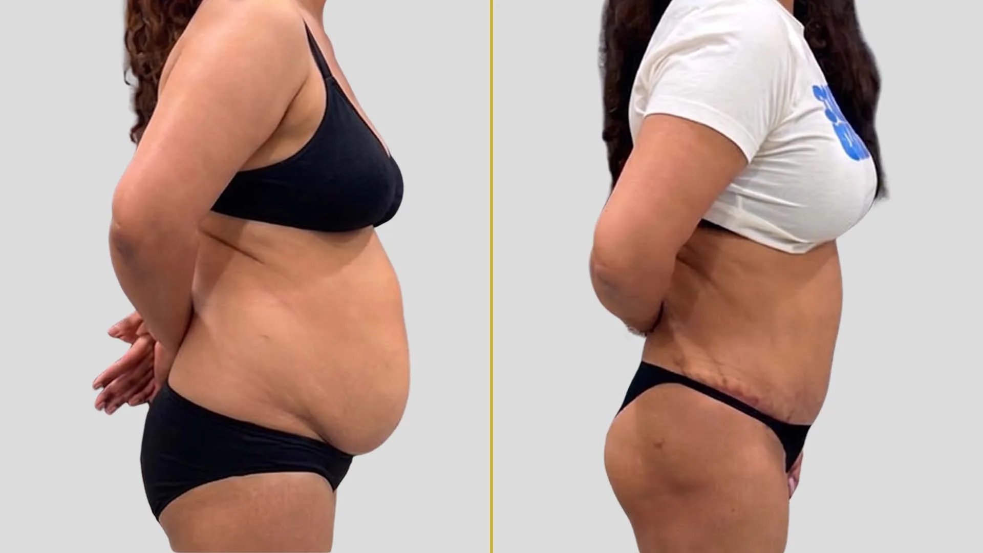 Tummy Tuck before and after result - The Hair and Shape Clinic, Mumbai