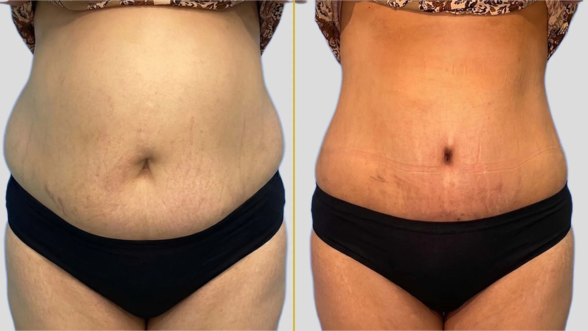 Tummy Tuck before and after result - The Hair and Shape Clinic, Mumbai