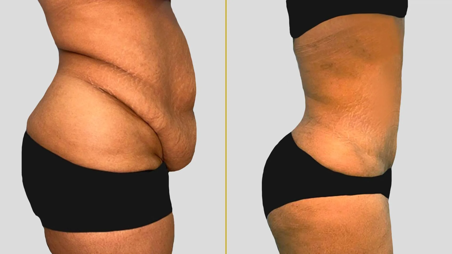 Tummy Tuck before and after result - The Hair and Shape Clinic, Mumbai