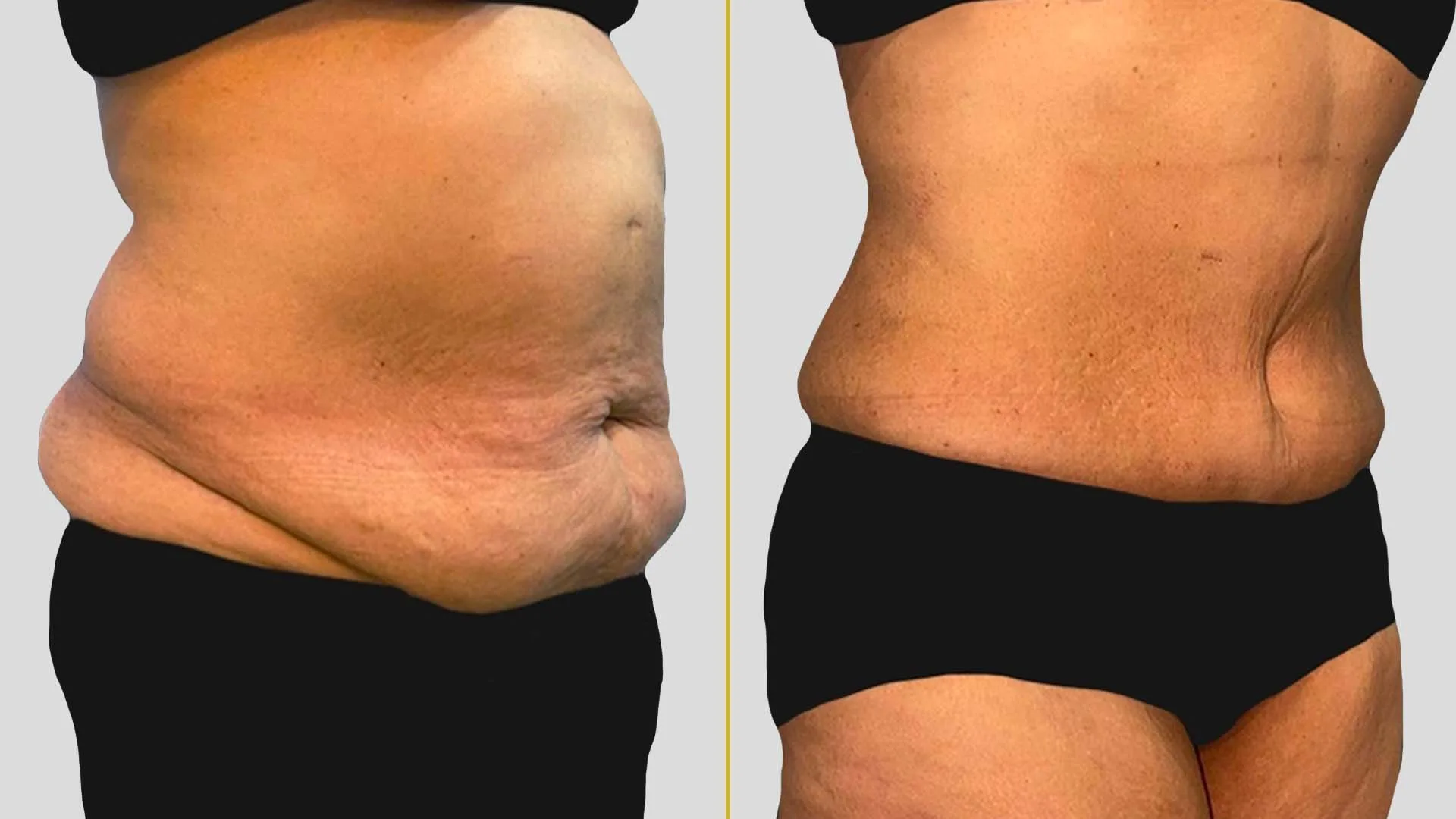 Tummy Tuck before and after result - The Hair and Shape Clinic, Mumbai