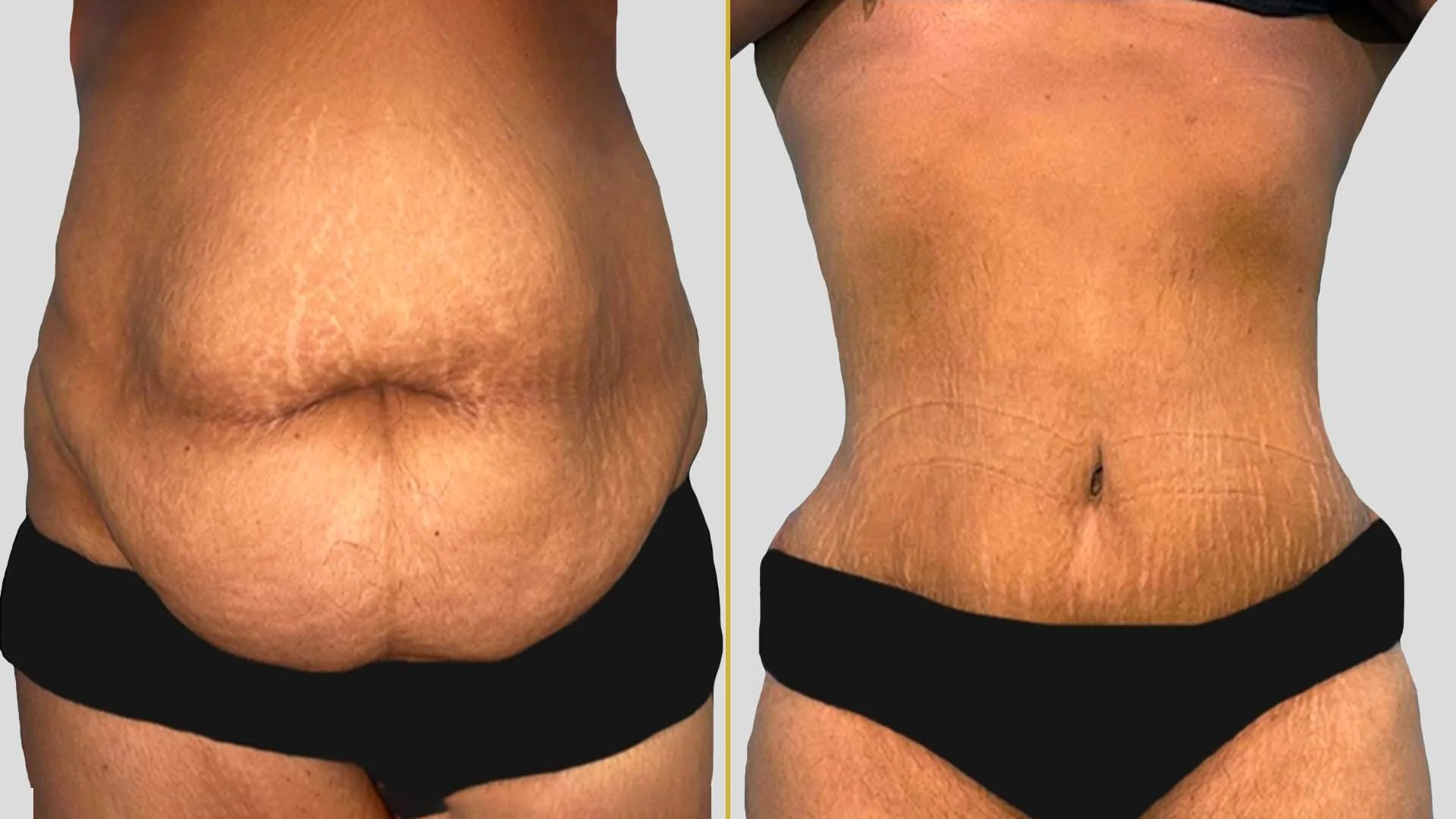Tummy Tuck before and after result - The Hair and Shape Clinic, Mumbai